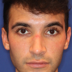JL Facial Balancing Before & After Patient #15540