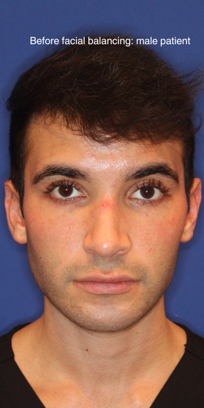 JL Facial Balancing Before & After Patient #15540