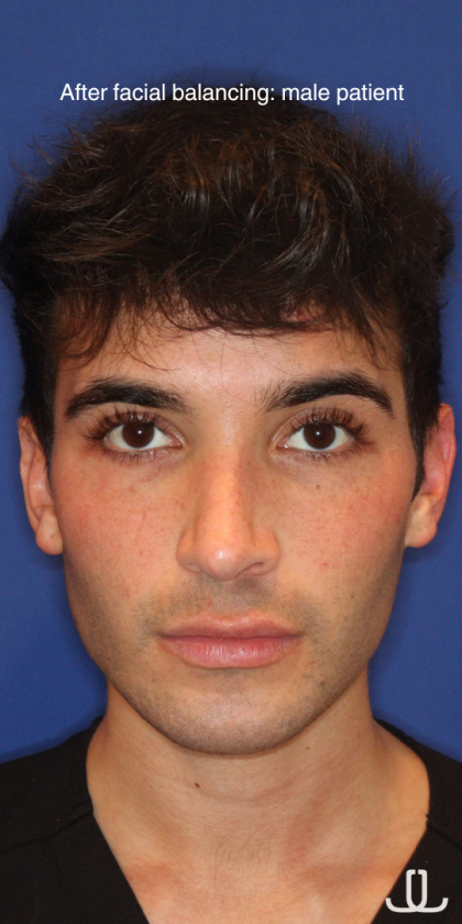 JL Facial Balancing Before & After Patient #15540