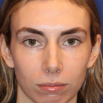 JL Facial Balancing Before & After Patient #15541