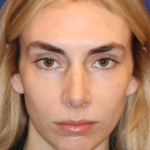 JL Facial Balancing Before & After Patient #15541