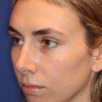 JL Facial Balancing Before & After Patient #15541