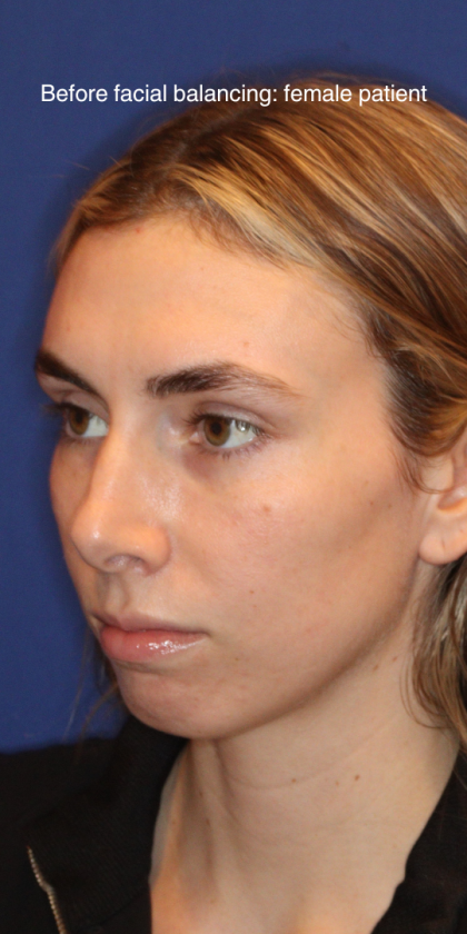 JL Facial Balancing Before & After Patient #15541