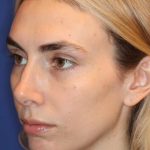 JL Facial Balancing Before & After Patient #15541