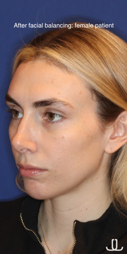 JL Facial Balancing Before & After Patient #15541