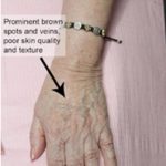 Hand Rejuvenation Before & After Patient #14188