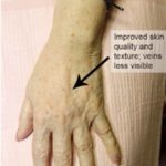 Hand Rejuvenation Before & After Patient #14188