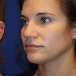 Lip Filler Before & After Patient #13831