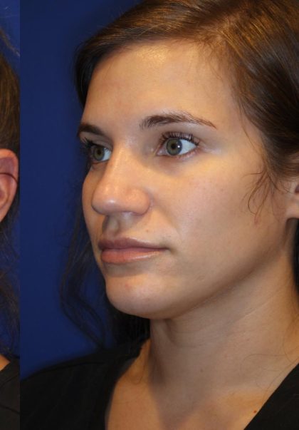 Lip Filler Before & After Patient #13831