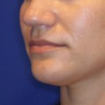 Lip Filler Before & After Patient #13831