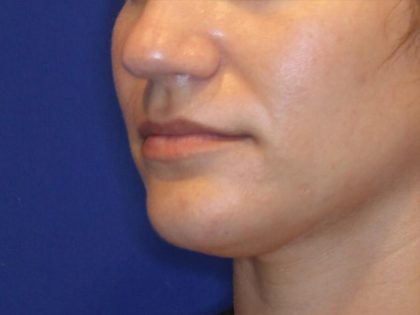 Lip Filler Before & After Patient #13831