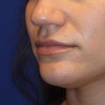 Lip Filler Before & After Patient #13831
