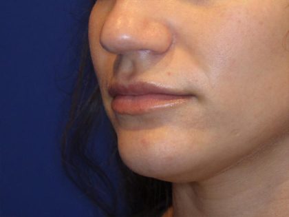 Lip Filler Before & After Patient #13831