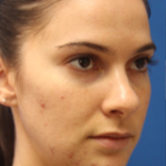 Lip Filler Before & After Patient #13830