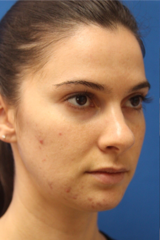 Lip Filler Before & After Patient #13830