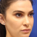 Lip Filler Before & After Patient #13830