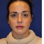 Lip Filler Before & After Patient #13829