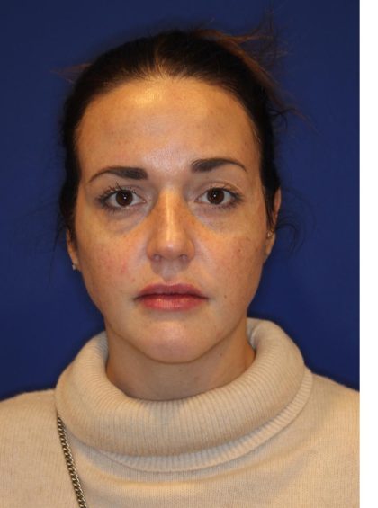 Lip Filler Before & After Patient #13829