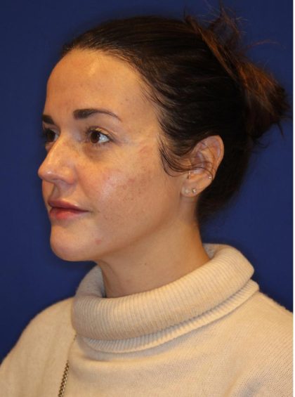Lip Filler Before & After Patient #13829