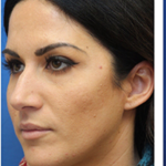 Lip Filler Before & After Patient #13828