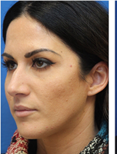 Lip Filler Before & After Patient #13828