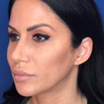 Lip Filler Before & After Patient #13828
