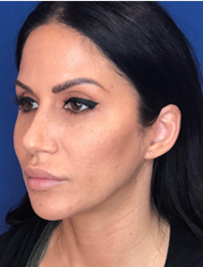 Lip Filler Before & After Patient #13828