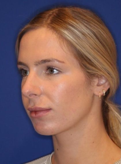 Lip Filler Before & After Patient #13825
