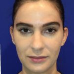 Lip Filler Before & After Patient #13822
