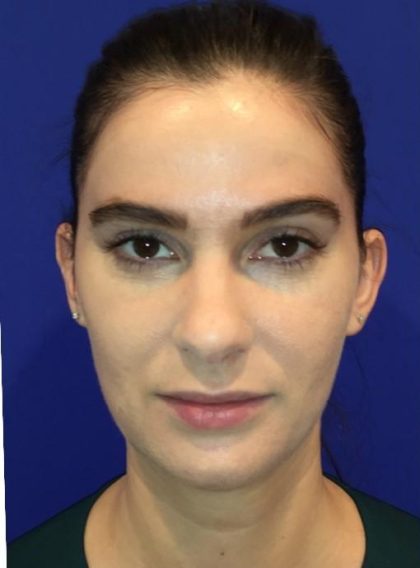 Lip Filler Before & After Patient #13822