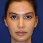 Lip Filler Before & After Patient #13822