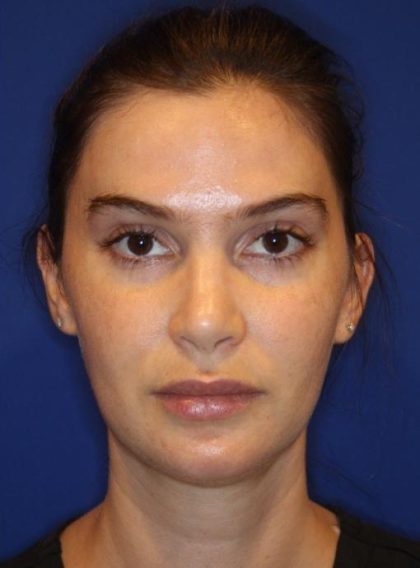 Lip Filler Before & After Patient #13822