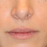 Lip Filler Before & After Patient #13824