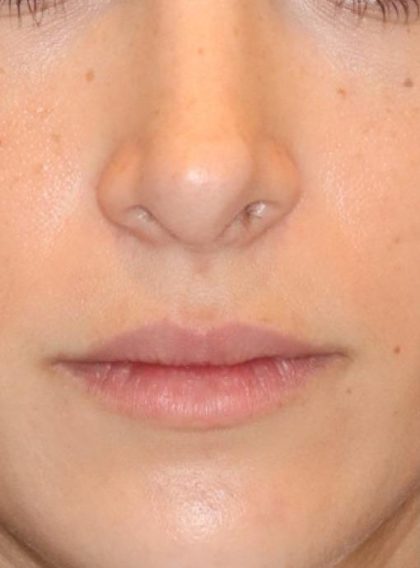 Lip Filler Before & After Patient #13824