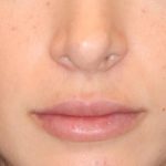 Lip Filler Before & After Patient #13824