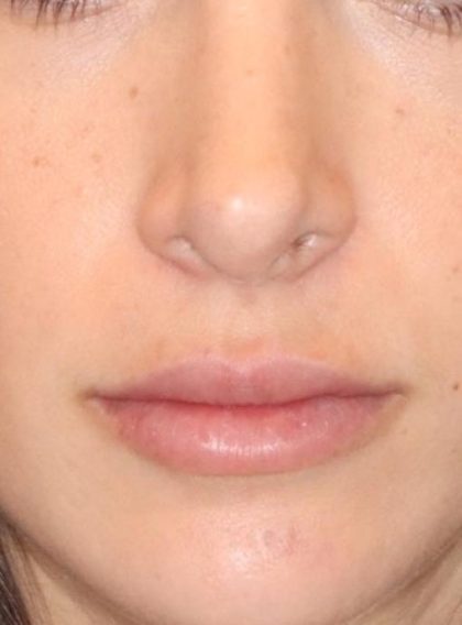 Lip Filler Before & After Patient #13824