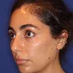 Lip Filler Before & After Patient #13840