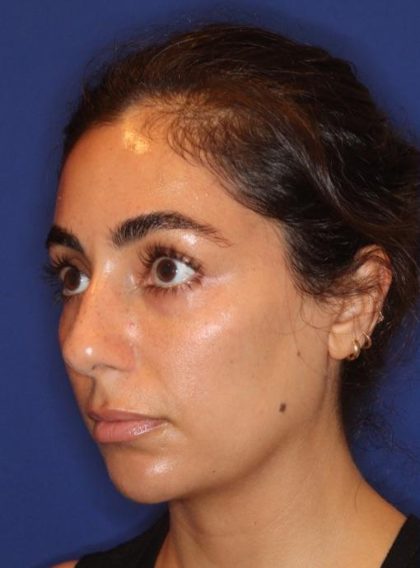 Lip Filler Before & After Patient #13840
