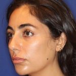Lip Filler Before & After Patient #13840