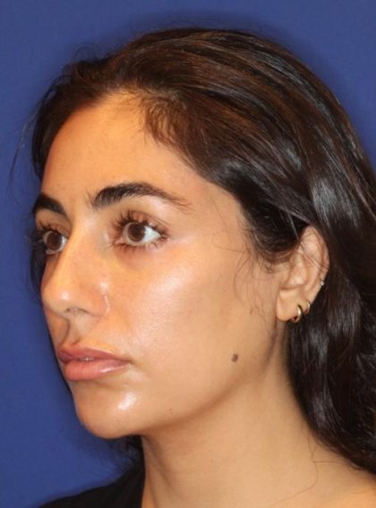 Lip Filler Before & After Patient #13840
