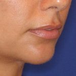 Lip Filler Before & After Patient #13839