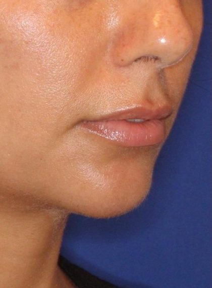 Lip Filler Before & After Patient #13839