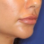 Lip Filler Before & After Patient #13839
