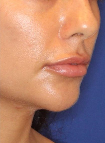 Lip Filler Before & After Patient #13839