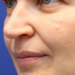 Lip Filler Before & After Patient #13838