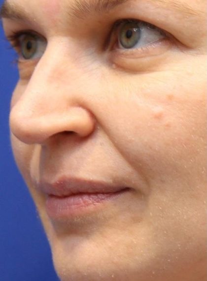Lip Filler Before & After Patient #13838