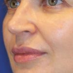 Lip Filler Before & After Patient #13838
