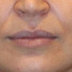 Lip Filler Before & After Patient #13836