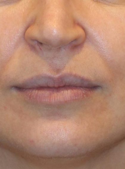 Lip Filler Before & After Patient #13836