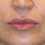 Lip Filler Before & After Patient #13836